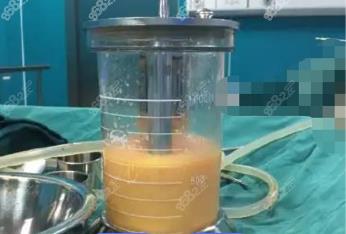 河间360度水动力吸脂费用多少钱？