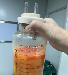 河间水动力吸脂手术要做多久？